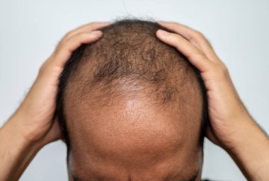 Asyalı adam kafasına dokunuyor ve kellik sorunu yüzünden stres altında..