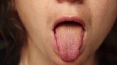 Beyaz ve Sarı Kaplamalı Genç Bir Kadın Dili 'nin Yakın Çekimi. Sağlık belirtileri. Dilini gösteren genç bir kadın. Rahatsızlık ve hastalığın belirtileri. Kapat..