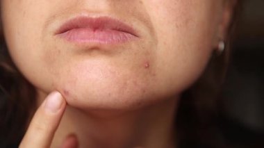 Genç Dokunan Sivilceli ve Kuru Dudaklı Kadın portresi. Cilt Bakımı Endişeleri. Sivilce ve Kuru Dudaklar. Gerçek Cilt Dokusu.
