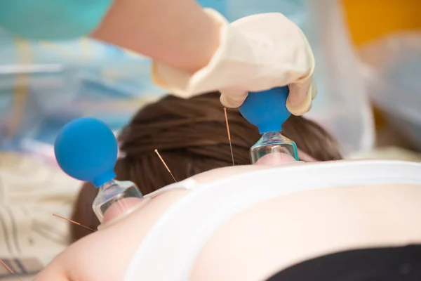 Doctor Makes Patient Acupuncture Vacuum Massage — Foto Stock