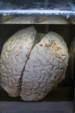 1 Nisan 2023 'te bir inme sonrası insan beyninin anatomik sergilenmesi. Antropoloji ve Etnografi Müzesi Sergisi.