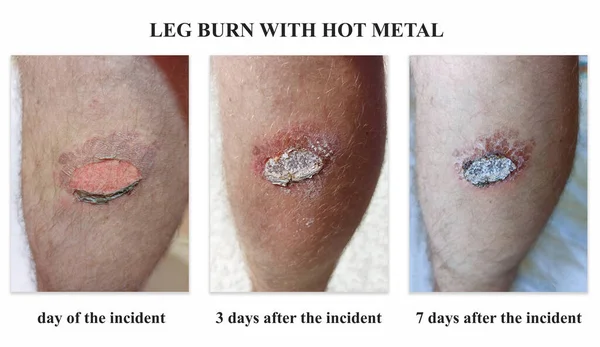 Poparzenie Nogi Gorącym Metalem Widok Ludzkiej Nogi Poparzeniu Gorącym Metalem — Zdjęcie stockowe