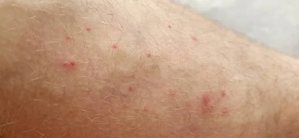 红蚊子叮咬 皮肤肿大 咬牙切齿 人类的皮肤表面有很多蚊子叮咬 蚊子咬人的身体 — 图库照片