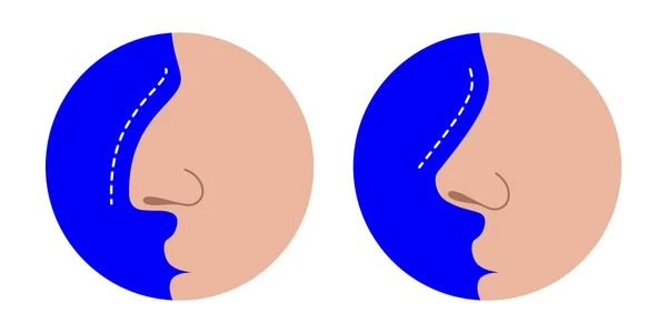 Krumme Und Gerade Nase Vor Und Nach Der Nasenkorrektur Nasen — Stockvektor