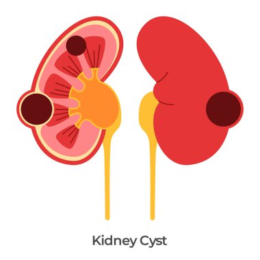 Böbrek kisti renal kist çizim anatomisi böbrek vektöründe sıvı dolu keselerin çizimi