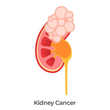 Böbrek kanseri mesane tümörü anatomi çizim vektörü
