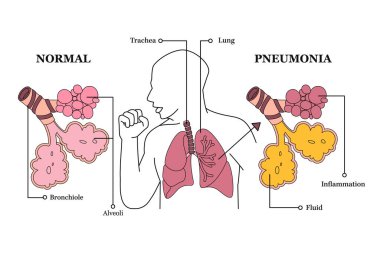 Sağlıklı bir akciğer ve akciğeri zatürree ile karşılaştıran tıbbi örnekleme. Normal bronşioller ve alveoller iltihaplanmış ve solunum hastalıklarının sıvı sağlık etkileriyle dolu.