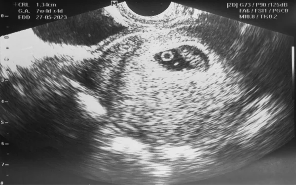 Exhibición Del Ultrasonido Del Bebé Embarazada Pantalla Panza Madre Hospital —  Fotos de Stock