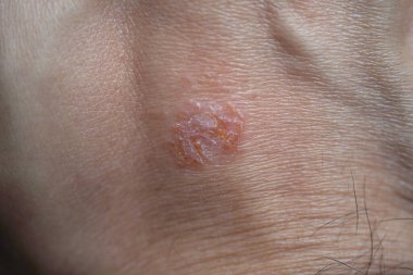 Nummular Dermatit derisini kapat.