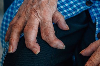 90 'lı yaşlarda osteoartriti olan bir kadının elleri.