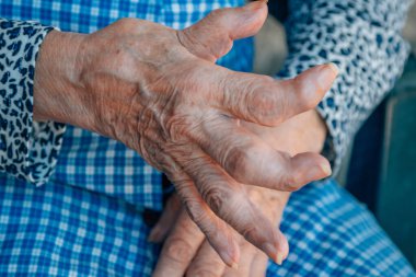 90 'lı yaşlarda osteoartriti olan bir kadının elleri.