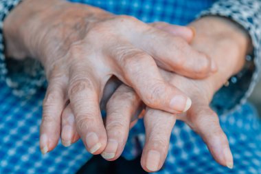 90 'lı yaşlarda osteoartriti olan bir kadının elleri.