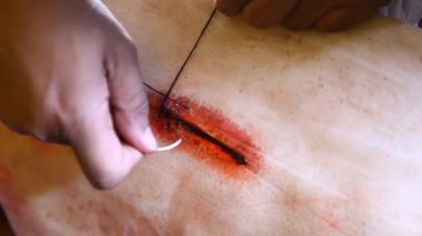 Ameliyattan sonra deriyi dikmiş.