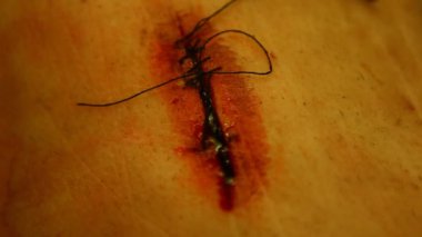 Ameliyattan sonra deriyi dikmiş.