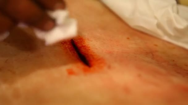 Angenähte Haut Nach Einer Operation — Stockvideo