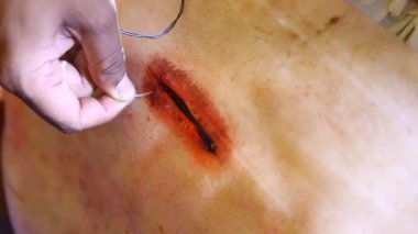 Ameliyattan sonra deriyi dikmiş.