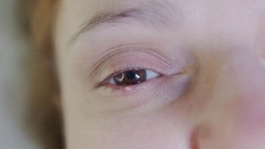 Close up of a woman eye stye. Red eye lid with onset of stye infection staphylococcal bacteria. High quality 4k footage