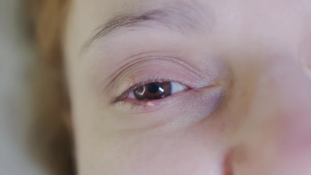 Närbild Kvinnlig Ögonstil Rött Ögonlock Med Debut Styvinfektion Stafylokockbakterier Högkvalitativ — Stockvideo