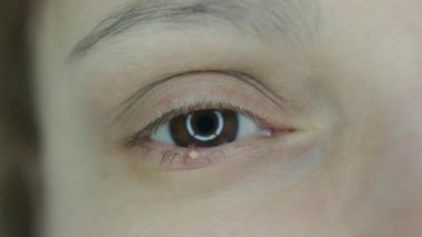 Close up of a woman eye stye. Red eye lid with onset of stye infection staphylococcal bacteria. High quality 4k footage