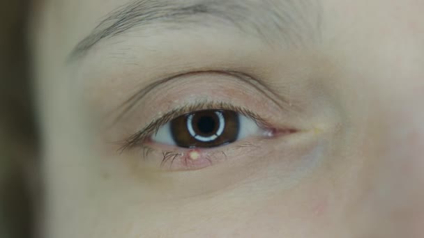 Närbild Kvinnlig Ögonstil Rött Ögonlock Med Debut Styvinfektion Stafylokockbakterier Högkvalitativ — Stockvideo