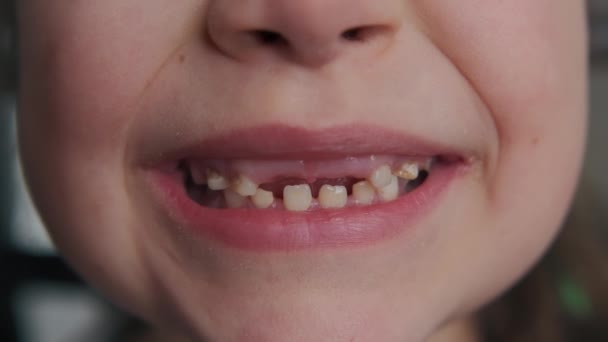 Крупним Планом Вигляд Дитячого Зуба Готовий Випасти Високоякісні Кадри — стокове відео