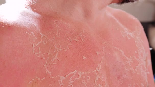 Man Skin Sunburn Seashore Close High Quality Footage — Stock Video