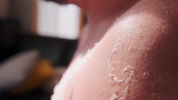Der Mann Erlitt Strand Einen Sonnenbrand Aus Nächster Nähe Hochwertiges — Stockvideo