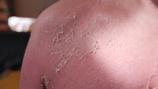 Man Skin Sunburn Seashore Close High Quality Footage — Stock Video