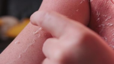 Deniz kıyısında güneş yanığı olan adam. Kapatın. Yüksek kalite 4k görüntü