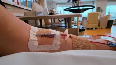 Ek kateter takılmış bir kadın kan bağışçısı ya da damar içi serum fizyolojikli bir hastane. Hastanelerdeki yataklarda tedavi ediliyor. Yüksek kalite 4k görüntü