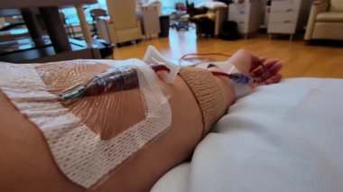 Tıbbi tedavi devam ediyor. Kadın hasta, bir sağlık merkezinde yatıyor. Sıvılar, ilaçlar ve besinler için serum. Yüksek kalite 4k görüntü