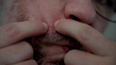 Yüzünde sivilce olan orta yaşlı bir adamın yüzü. Yüksek kalite 4k görüntü