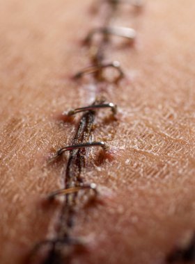 Organ nakli ameliyatından sonra cerrahi bir kesiğin ve yaranın iyileşmesine yardımcı olan tıbbi zımbaların kapatılması.