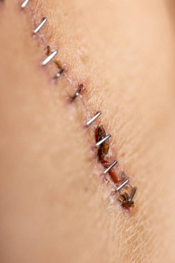 Organ nakli ameliyatından sonra cerrahi bir kesiğin ve yaranın iyileşmesine yardımcı olan tıbbi zımbaların kapatılması.