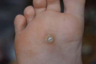 Bir çocuğun ayağında ayak siğili. Papillomavirus Vart verrucas plantar.