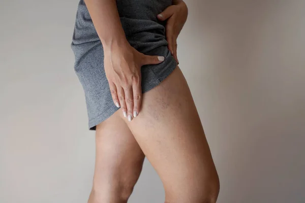 Vena Varicose Yang Menyakitkan Pada Kaki Wanita — Stok Foto