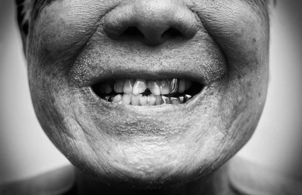 The unhealthy teeth of an Asian elder cracked from old age. Metal teeth. Black and white tone