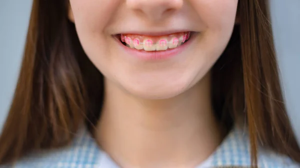 Chica Con Mordida Correcta Tratamiento Ortodoncia Concepto Cuidado Dental Niña —  Fotos de Stock