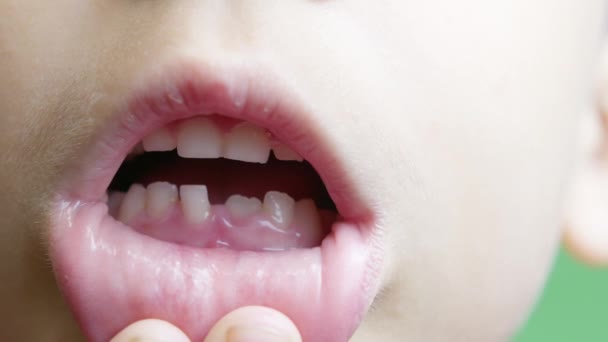 Zblízka Chlapec Otevře Pusu Ukáže Mléčné Zuby Jeden Chybějící Zub — Stock video