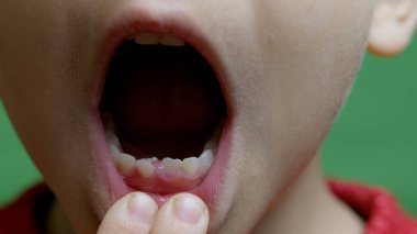 Yaklaş, çocuk ağzını açar ve süt gibi dişlerini gösterir. Eksik bir diş yerine kalıcı bir çınlama. - Evet. Yüksek kalite fotoğraf