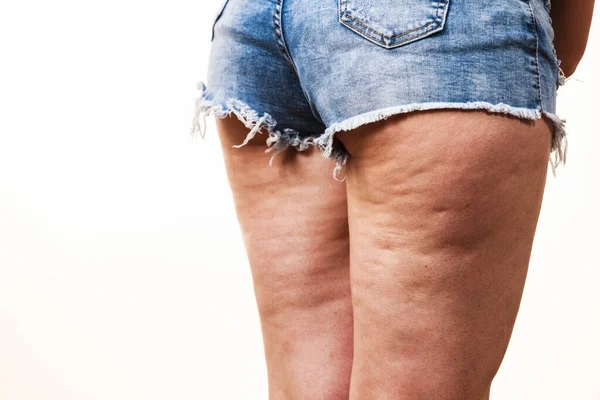 Жінка Ноги Стегна Проблеми Шкірою Целюліту Догляд Тілом Надмірна Вага — стокове фото