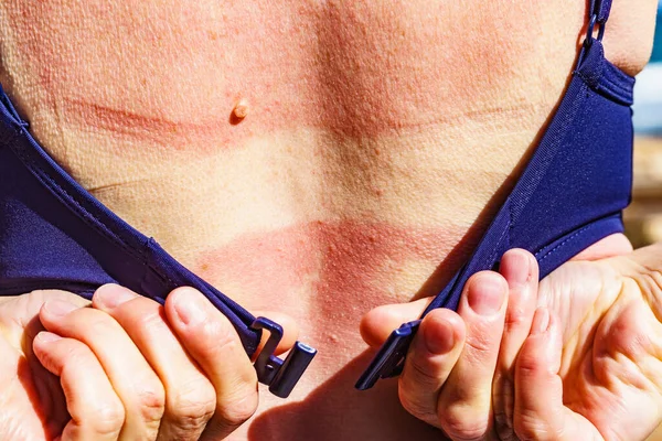 Λευκή Γυναίκα Πλάτη Και Ώμοι Δέρμα Πληγωμένο Από Ηλιακό Έγκαυμα — Φωτογραφία Αρχείου