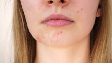 Genç bir kadın sivilcelerle ve benlerle yüzünü gösteriyor. Genç kız çenesinde kırmızı lekelerle makyaj yapmaz. Sağlık sorunları, deri hastalıkları.