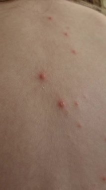 Bir çocuğun sırtında suçiçeği kızarıklığı.