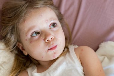 Virüs hastalığı. Suçiçeği yüzünden yüzünde isilik olan, antiseptik bulaşmış bir kızın yakın plan portresi.