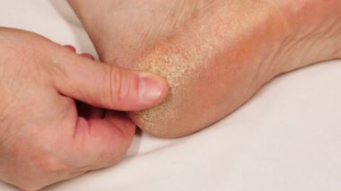 Topuğu çatlamış, derisi pürüzlü. Adam topuklarındaki derinin çatırdamasına ve soyulmasına dokunur. Deri sorunu. Dermatoloji hastalığı. Ayaklar tıbbi bakım ve pedikür gerektirir. Yakın plan. 4k video