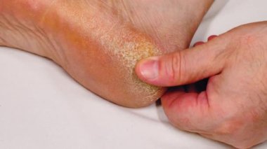Topuğu çatlamış, derisi pürüzlü. Ağır çekim. Adam topuklarındaki derinin çatırdamasına ve soyulmasına dokunur. Deri sorunu. Dermatoloji hastalığı. Ayaklar tıbbi bakım ve pedikür gerektirir. Yakın plan.