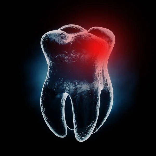 Medically Accurate Aching Tooth X-Ray View with Red Zone of Pain on a black background. 3d Rendering