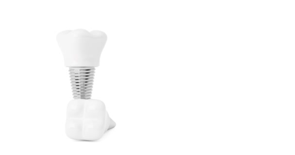 Resolution Video Konsep Gigi Tooth Implants Seamless Looped Rotating White — Stok Video