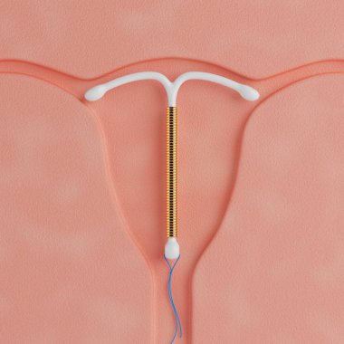 Doğum Kontrol Konsepti. Rahim içinde T Şekli IUD Bakır Rahim İçi Cihaz Aşırı yakın çekim. 3d Hazırlama